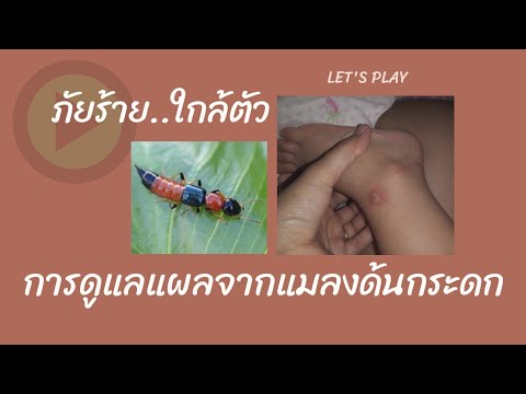 มาเล่นกันเถอะ l รีวิวบาดแผล ดูแลรอยแผลเป็นจากแมลงกระดก l Kael Let&39;s Play