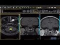 Schwannoma on brain MRI With Drs. Stephen Pomeranz and Malcolm Shupeck