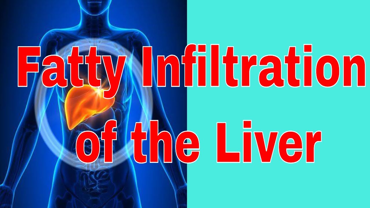 Mild Fatty Infiltration Of The Liver YouTube