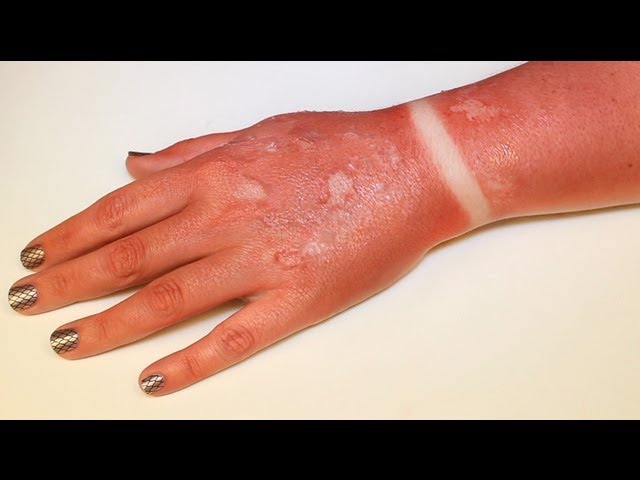 first degree burn hand