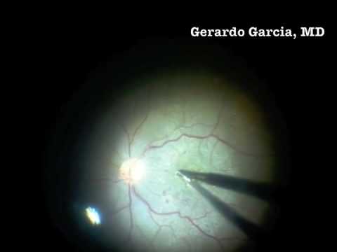 Procedure consisting of vitrectomy using 23G instruments, posterior hyaloid separation, epiretinal membrane using end-grasping forceps, and air-fluid exchange. Gerardo Garcia-Aguirre, MD, Asociacion para Evitar la Ceguera en Mexico, Mexico City