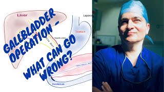 UNDERSTANDING COMPLICATIONS OF GALLBLADDER OPERATION (laparoscopic cholecystectomy), KEYHOLE SURGERY