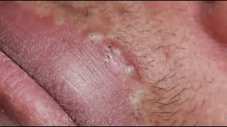 LOTS OF BLACKHEADS AROUND THE LIPS  😨 GREAT JOB SOPHIA #relaxing  #blackheads