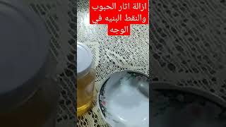 وصفة لازالة اثار الحبوب