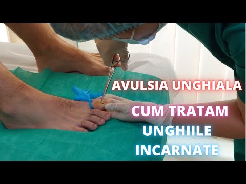 Avulsie Unghiala (unghie incarnata) | Testimonial pacient DermaBeauty Clinique