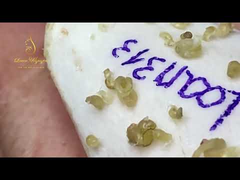 Best blackheads removal (313-2) | Loan Nguyen