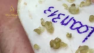 Best blackheads removal (313-2) | Loan Nguyen