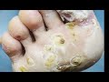 Meta warts calluses foot niva stream