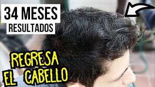 34 Meses RECUPERANDO el CABELLO con MINOXIDIL ¡RESULTADOS! | Tratamiento Alopecia