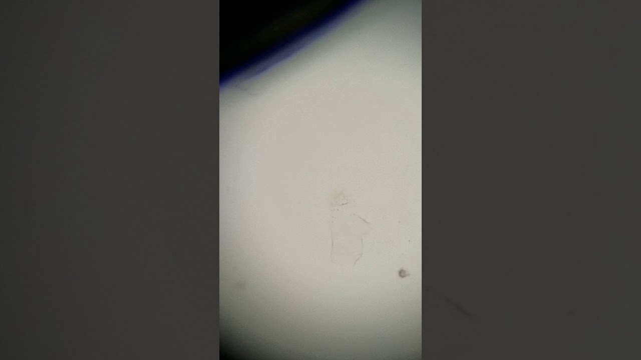 Urinalysis: Manual Microscopic #3