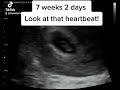Flickering Heartbeat at 7 weeks 2 days on the Pregnancy Ultrasound