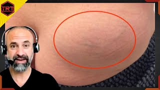 How to Avoid Testosterone Injection Site Swelling or Lumps