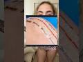 HIP REPLACEMENT RECOVERY DAY 10 💙 Anterior “Bikini Cut” Incision Reveal