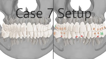 Maestro 3D aligners virtual setup: case 7, upper jaw distalization, lower jaw severe crowding