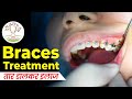 Teeth braces patient review  braces      usha smile care sikar  dr bhavya punia