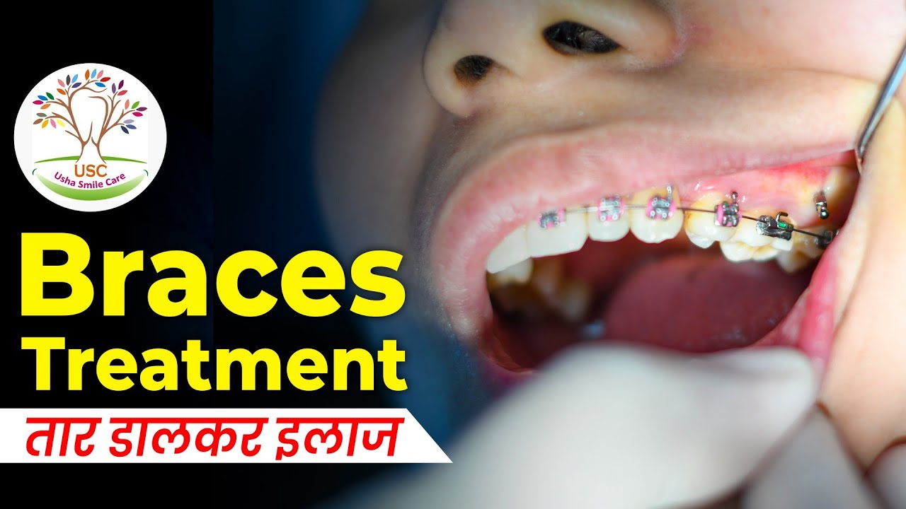 Teeth Braces Patient Review Braces Usha Smile teeth-braces-patient-review-braces-usha-smile