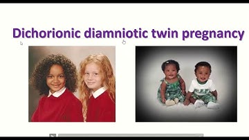 Anatomy of dichorionic and diamniotic twin pregnancy with sonographic feature
