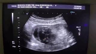 SUBCHORIONIC BLEED in a TWIN pregnancy