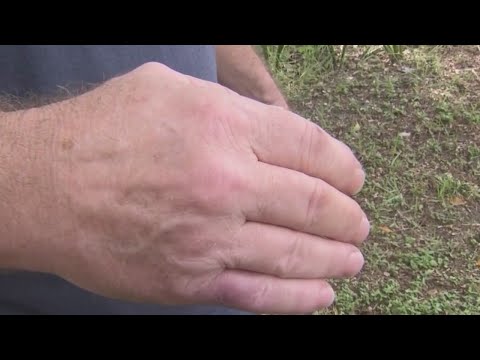 cellulitis ant bite