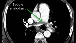 Sub Massive And Massive Pulmonary Embolism.