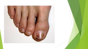 Frostbite: Patholgy, Clinical features and Management