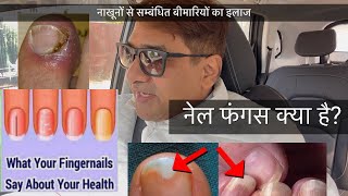 How to cure Discolored finger & Toenail | नाखून मे सक्रमण | Top Homeo-Mecicine -Home Remedy for Nail