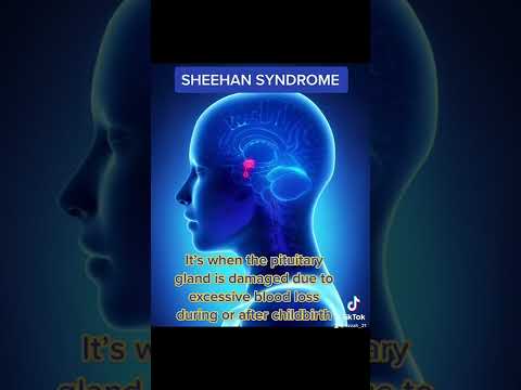 Video: Sheehani sündroom – põhjused, sümptomid ja ravi
