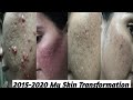My skin transformation part2  20152020 remove my acne scars journey   