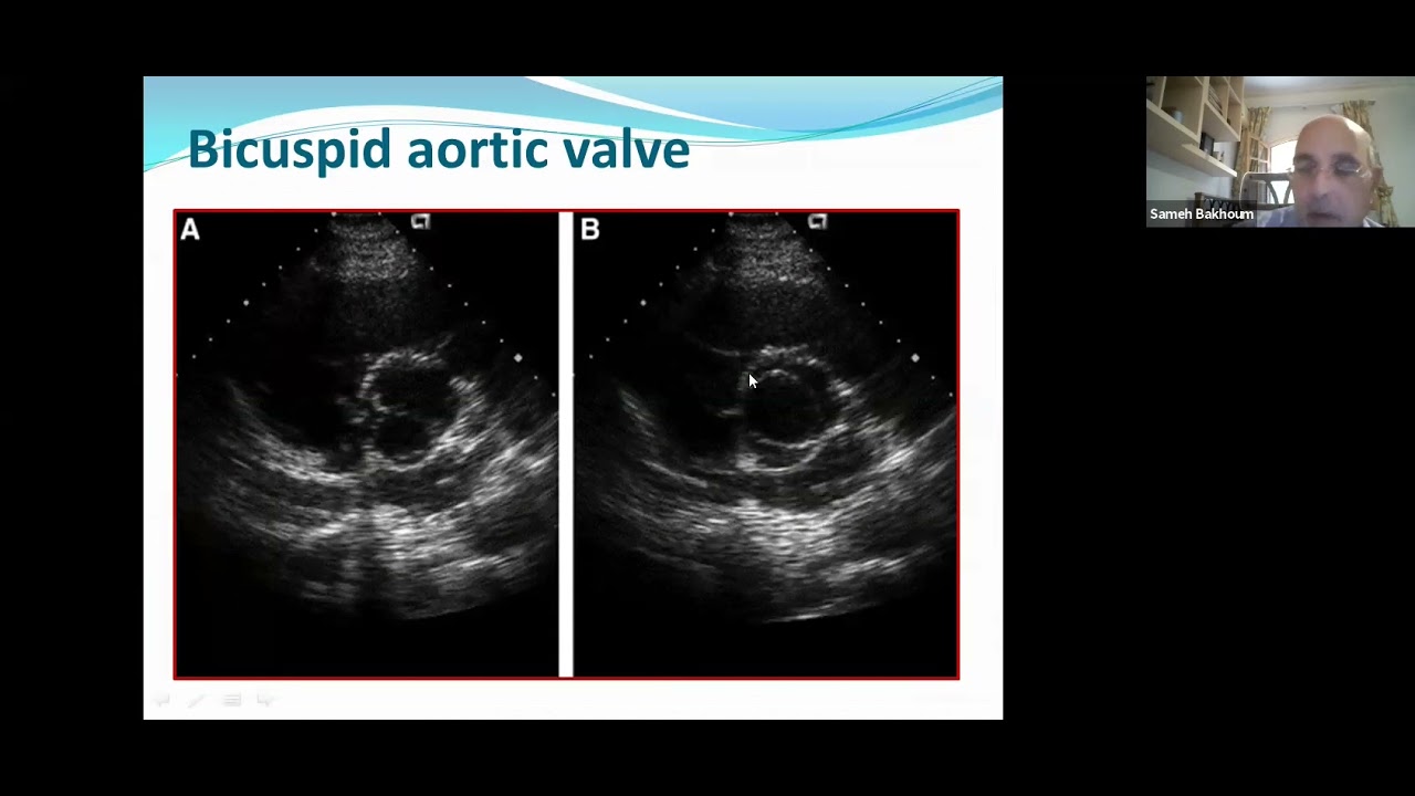 3- Echo assessment of AS - Prof. Sameh Bakhoum