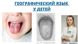 Географический язык. О каких заболеваниях свидетельствует данное состояние. Десквамативный глоссит.