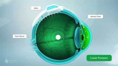 Glaucoma Shunt - Ahmed Valve