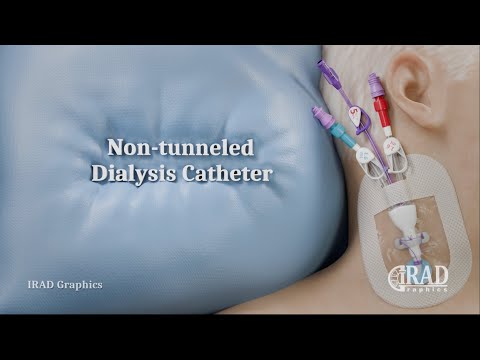 Dlc Procedure For Dialysis