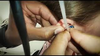 Kudutip Eartip Insertion