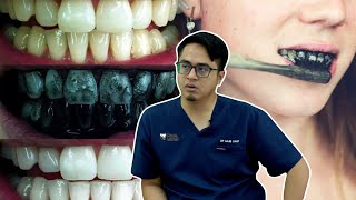 Pemutihan Gigi: Arang dan Veneer