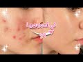 كيف عالجت جميع مشاكل بشرتي في المنزل بدون أى تكاليف سلسلة ال GLOW UP 