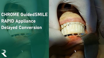 CHROME GuidedSMILE: RAPID Appliance Delayed Conversion