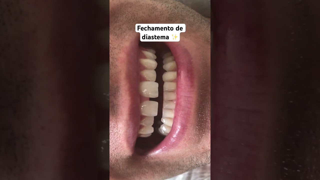 Resina composta fechando um diastema 💛 
