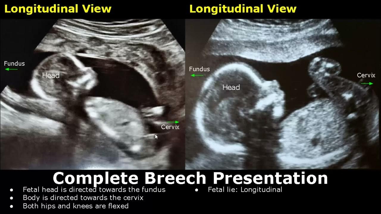 ultrasound fetal presentation breech