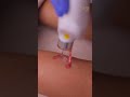 Unmapped Stretch Mark Removal | Tune Clinical Aesthetics (Coimbatore &amp; Chennai)