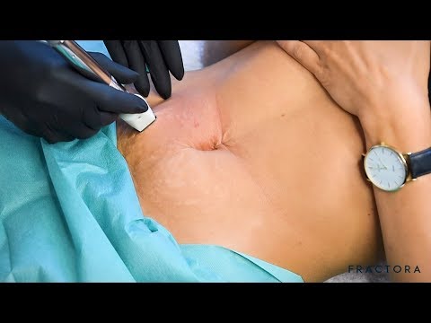 Dr Natalie Keller Straffung Von Schwangerschaftsstreifen Und Gewebe Am Bauch Mit Radiofrequenz Youtube