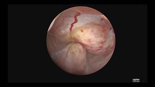 Hysteroscopic Removal of Submucosal Fibroid Using BIGATTI Shaver (Karl Storz) |