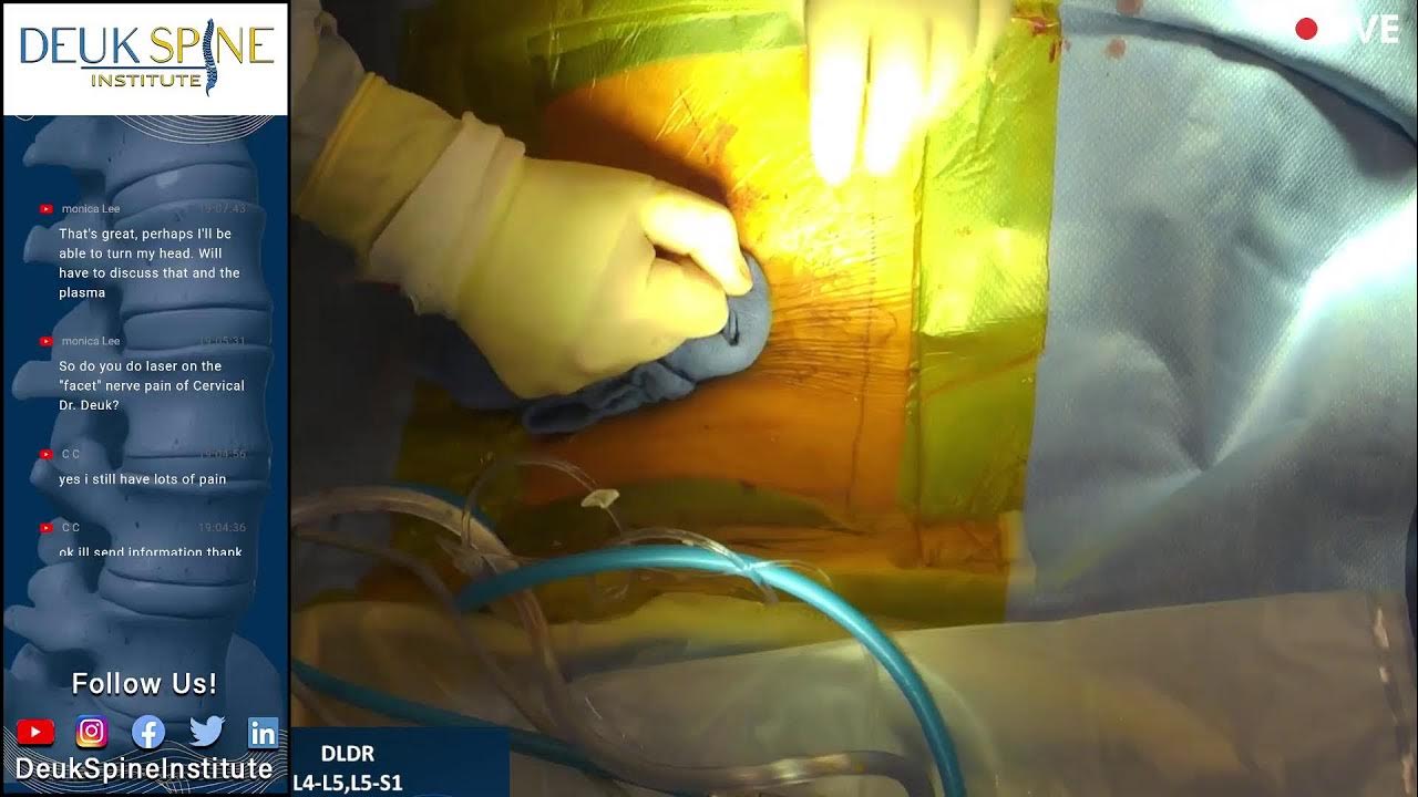 Deuk Laser Disc Repair, Spine Surgery Outpatient RT L4L5,L5S1 YouTube