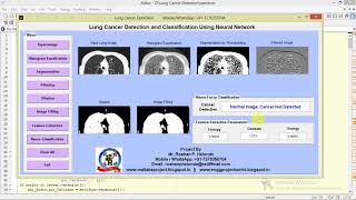 Matlab code for Lung Cancer Detection and Classification Using Neural Network
