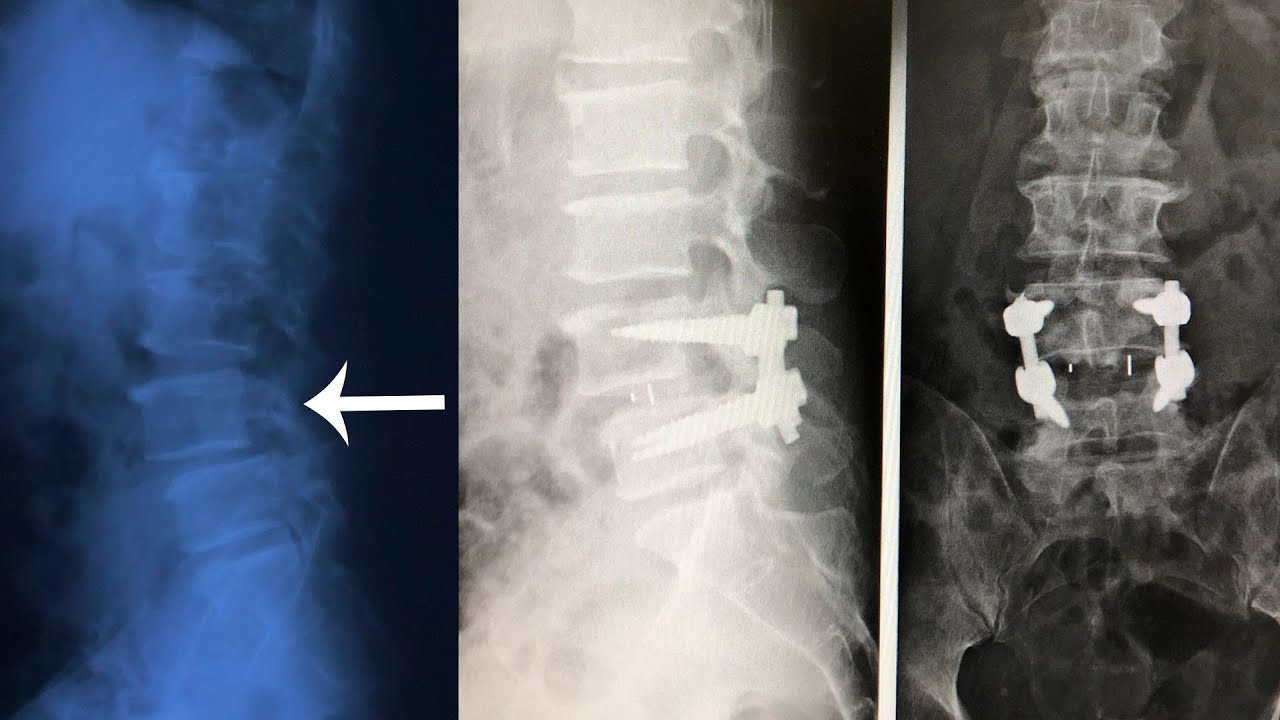 Дают ли инвалидность после операции на позвоночнике. Спондилолистез поясничного отдела рентген. Спондилолистез l5 операция. Спондилолиз l4. Операции спондилолистез позвоночника.
