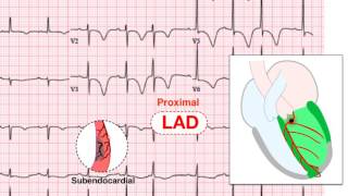 Ischemia 5/7 -Examples of UA and NSTEMI