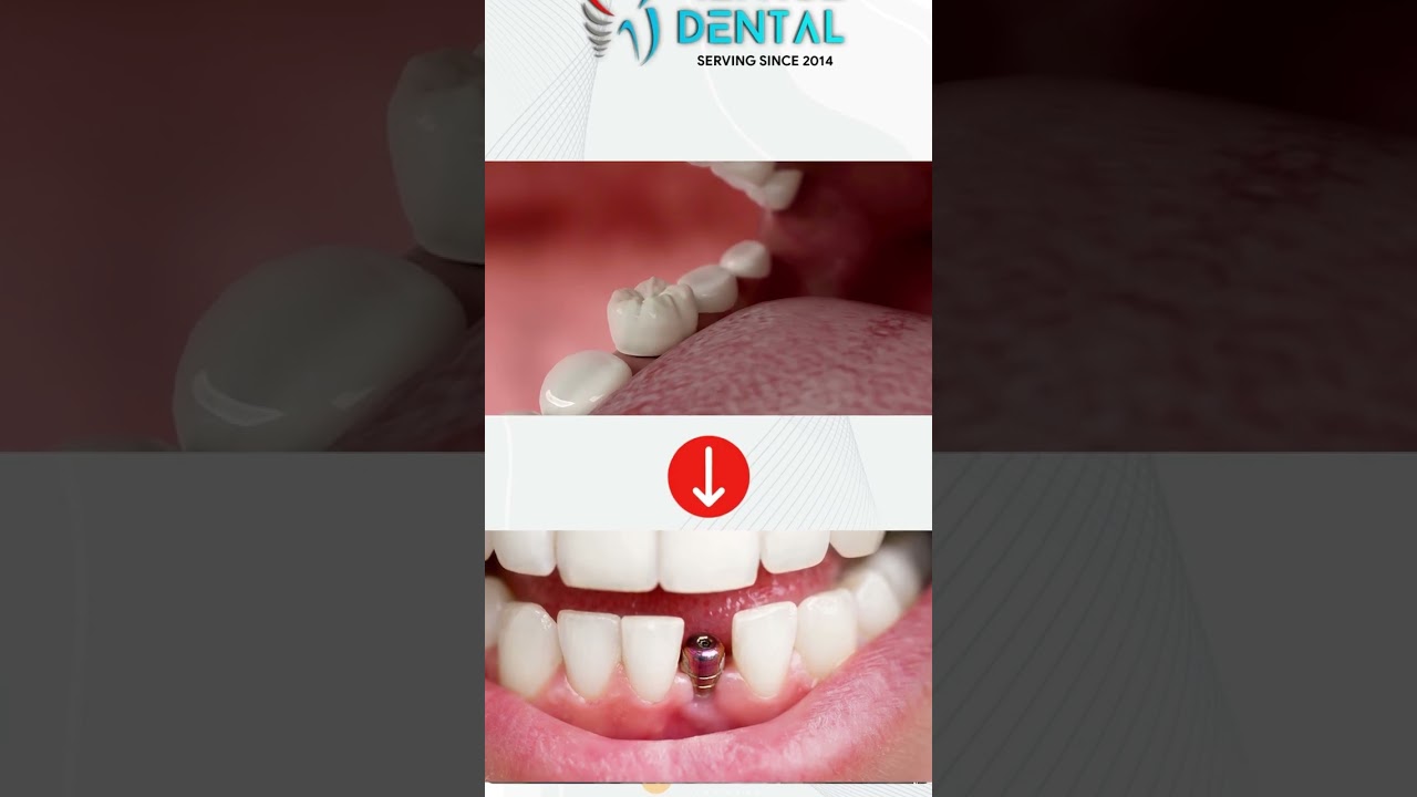 Immediate Loading Implantology | Consult For Any Dental Implant Treatment | Reface Dental Meerut