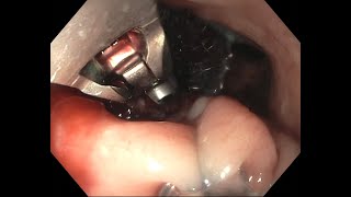 Florida Live Endoscopy Educational Video - Management of malignant hilar stricture in gastric bypass