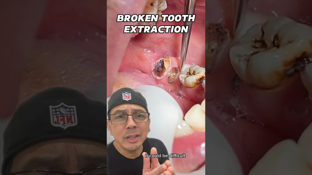 Broken Tooth & Root Tip Extraction (EASY) | In Office to Hands On ...