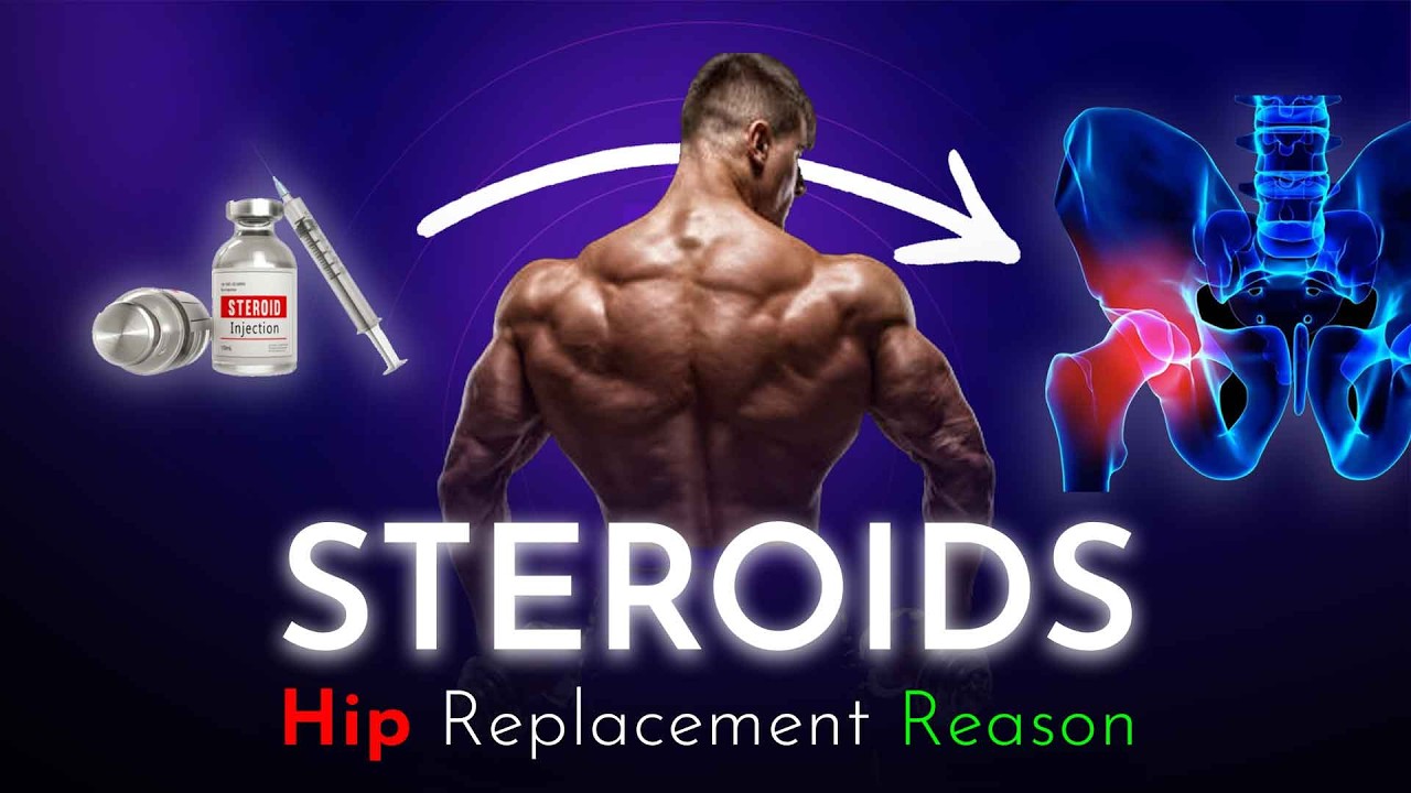 स्टेरॉयड्स से होते है कुल्हे ख़राब- Hip replacement