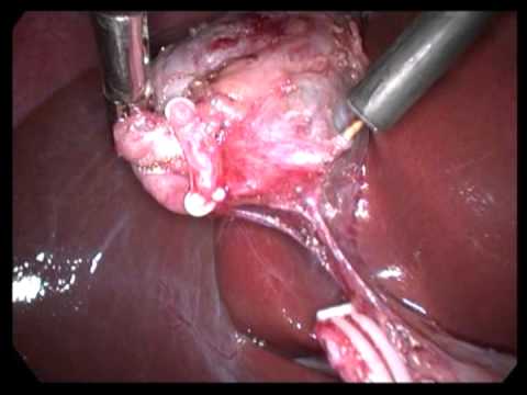 Laparoscopic Cholecystectomy (unedited-68)-Moderate Adhesion Clean Surgery